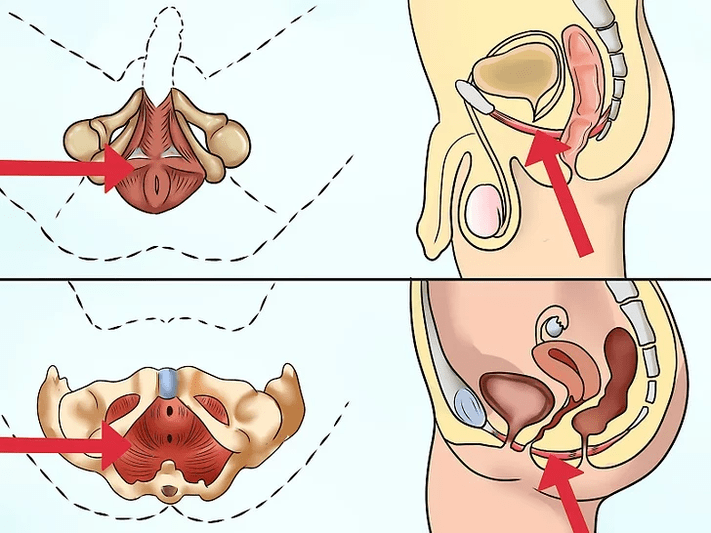A pubococcygeus izom, amelyet meg kell feszíteni a Kegel-komplexum végrehajtása során